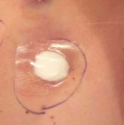 Срещу настинка, менструални болки, грип, кашлица и болки в корема - памук с ракия на пъпа