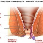 Симптоми и лечение на хемороиди