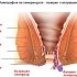 Симптоми и лечение на хемороиди