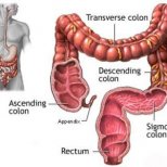 Рак на дебелото черво-симптоми и лечение