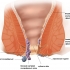 Хемороиди - природни средства за лечение