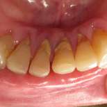 Защо е вреден зъбният камък за зъбите