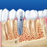 Какво е по-добре - щифтове, или импланти? Всички капани при имплантиране на зъби-Каква е процедурата