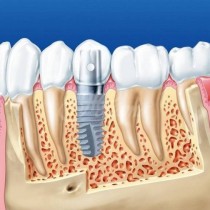 Какво е по-добре - щифтове, или импланти? Всички капани при имплантиране на зъби-Каква е процедурата