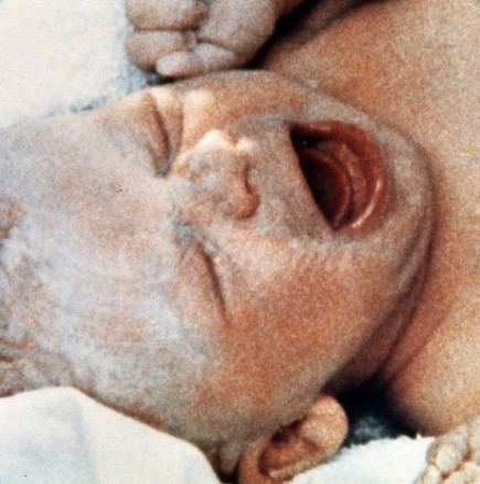 Бебето, което промени целия свят към по-добро-То беше уникално по рода си, когато се роди