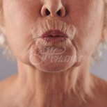5 домашни маски, които премахват дълбоките бръчки около устата