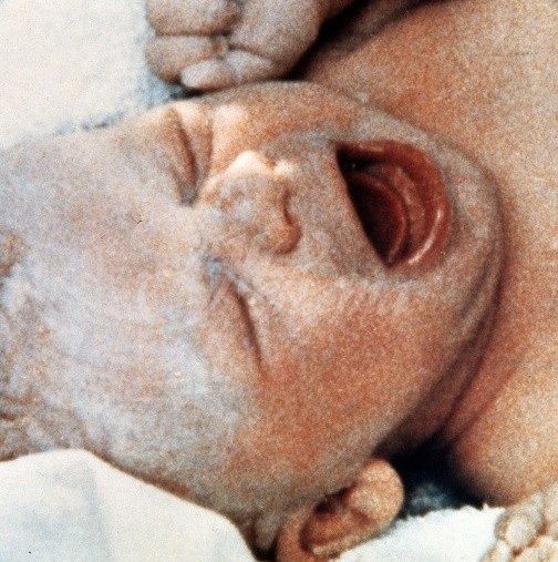 Бебето, което промени целия свят към по-добро-То беше уникално по рода си, когато се роди