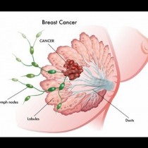 Броят на заболелите жени от рак на гърдата в България се увеличава постоянно, а възрастта намалява