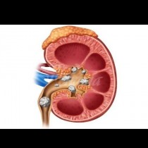7те алармиращи сигнала на тялото за камъни в бъбреците