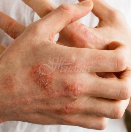 Дерматит на ръцете: причини, симптоми и естествени лекарства