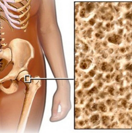 Тримата най-добри защитници на костите от остеопороза