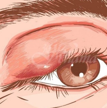 Как да излекуваме ечемика на окото си