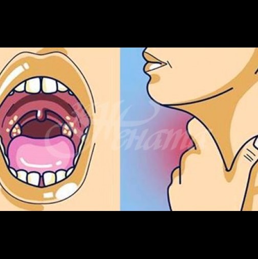 Болки в гърлото: 5 мощни рецепти бързо се отървете от болка! 