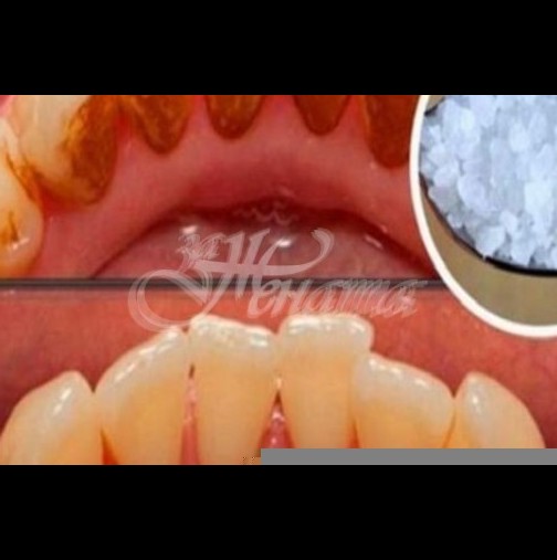Премахване на зъбния камък без помощта на зъболекар, само с натурални средства
