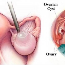 Кисти на яйчниците: причини, симптоми и рецепти за бързо елиминиране!