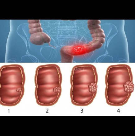 6-те Тихи симптоми на рак на дебелото черво, които никога не игнорирайте!  