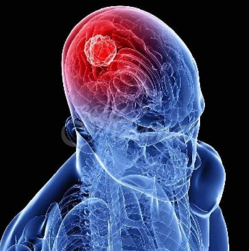 Онколозите разкриха първи симптом на рак на мозъка