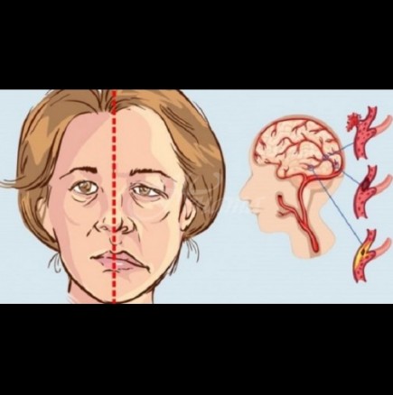 Първа помощ при инсулт: запомнете само 3 неща и може спасите себе си и другите: