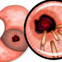 7 мощни средства убиват бактерии, които причиняват рак на стомаха, язви, гастрит, подуване на корема, алергии