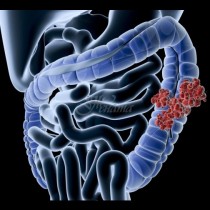 Три признака на рак на червата, които нерядко пренебрегваме