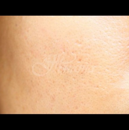 Разширени пори на лицето: 7 най-ефективни продукта за идеално гладка кожа!