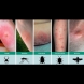 Внимание - лято! 5-те най-често срещани ухапвания от насекоми и какво да правим при всеки от тях: