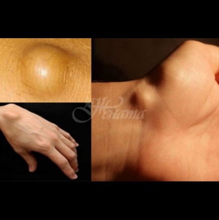 Ако имате подобни мастни топчета под кожата, непременно трябва да знаете тези неща: