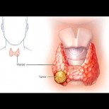 Възли в щитовидната жлеза: симптоми и причини