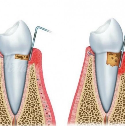 Признаци, че имате зъбен абсцес и как да го лекувате по естествен начин