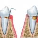 Признаци, че имате зъбен абсцес и как да го лекувате по естествен начин