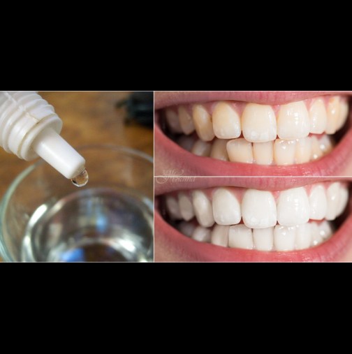 1 капка от вълшебната течност избелва зъбите с 2-3 тона, чисти зъбен камък и лош дъх! Лекува дори възпаленото гърло: