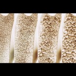 Лечение и профилактика на остеопороза: 7 начина за увеличаване на костната плътност
