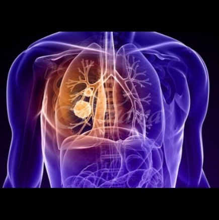 Ето по какво се разпознава рак на белия дроб
