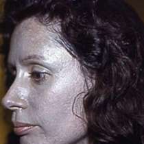 Жена пострада след редовна употреба на капки за нос. Вижте какво стана с лицето й