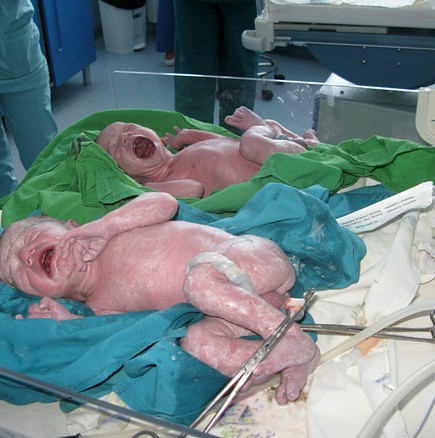 Жена на 63 години роди близнаци