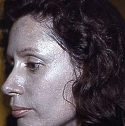 Жена пострада след редовна употреба на капки за нос. Вижте какво стана с лицето й