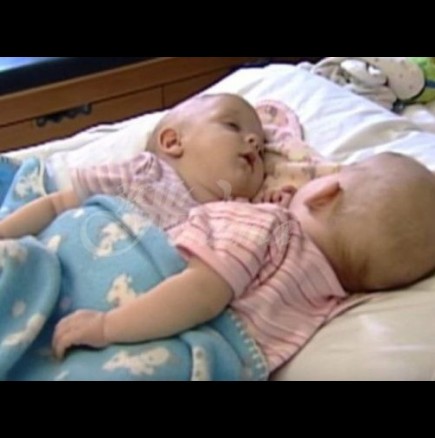 Краят на историята за раздялата на сиамските близнаци-Ето какво се случи 13 години по-късно!