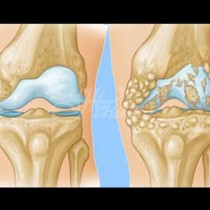 Причини за остеоартрит на колянната става и справяне с проблема