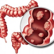 Намалявате риска от рак на дебелото черво до незначителен със спазването на 8 правила