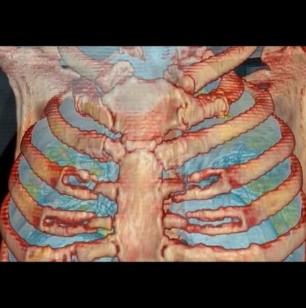 Показаха видео как изглеждат белите дробове на човек болен от коронавирус