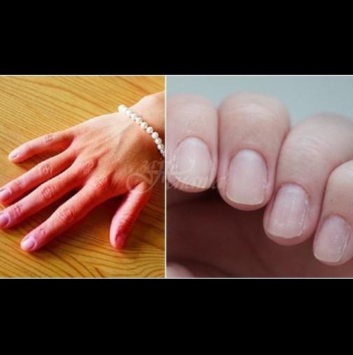 Тези видими промени в ръцете са сигнал за сериозно заболяване - не ги пренебрегвайте: