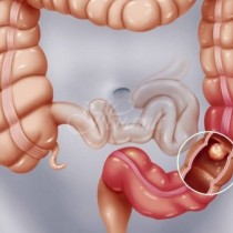 Световен пробив в предотвратяване на рак на дебелото черво 