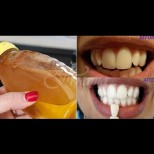 Домашен Листерин за зъби като от реклама - 1 съставка чисти петна и лош дъх, дезинфекцира устата: