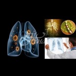 Как да разпознаем пневмония без кашлица?