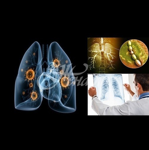 Как да разпознаем пневмония без кашлица?