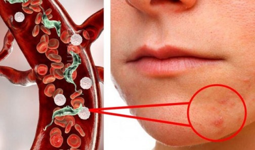 12 сигурни признака, че тялото ти гъмжи от паразити, които се хранят от теб и те разболяват: