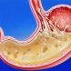 Защо киселинността е опасна и как да се лекува гастрит