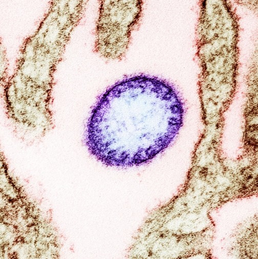 Уважавани учени предупреждават-Нов вирус причинява нова пандемия със 75 процента смъртност
