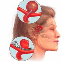 Мозъчната аневризма няма пощада - ето първите ѝ предупредителни симптоми: