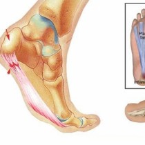 Плантарен фасциит-Как да се отървете от болката и да не се объркате при лечението